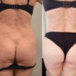 AcquaLipo – La liposcultura gentile approvata dalla scienza