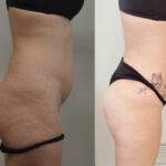 AcquaLipo – La liposcultura gentile approvata dalla scienza