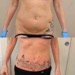 AcquaLipo – La liposcultura gentile approvata dalla scienza