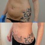 AcquaLipo – La liposcultura gentile approvata dalla scienza