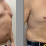 Liposuzione addome uomo &#8211; grasso viscerale ?