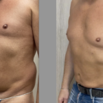 Liposuzione addome uomo &#8211; grasso viscerale ?